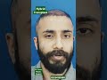 #besthairtransplant lahore #dhi transplant #prp #aestheticplasticsurgery