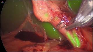 1688 Aim 4K Laparoscopic Cholecystectomy