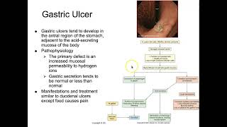 AHS 280: Chapter 41 - Alterations of Digestive Function (Part 3: Gastritis, Peptic Ulcer Disease, &