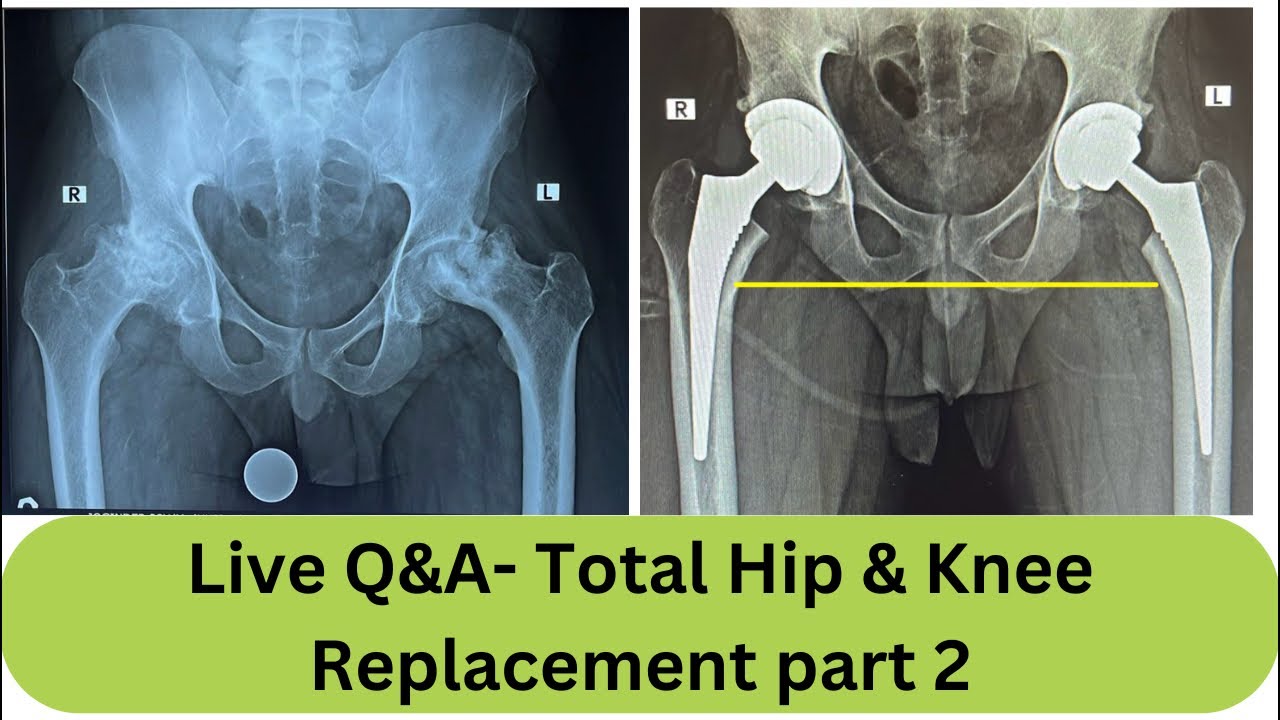 Live Q&A part 2-Total hip & Total knee replacement, 25.08.2024 - YouTube