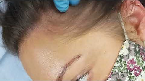 Female Hairline Scalp Micropigmentation SMP by El Truchan @ Scalp Micro Definition