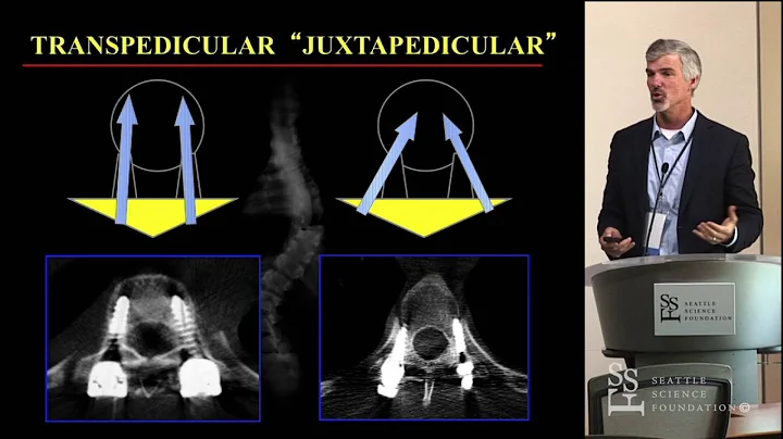 Thoracic Pedicle Screws - Michael Daubs, MD