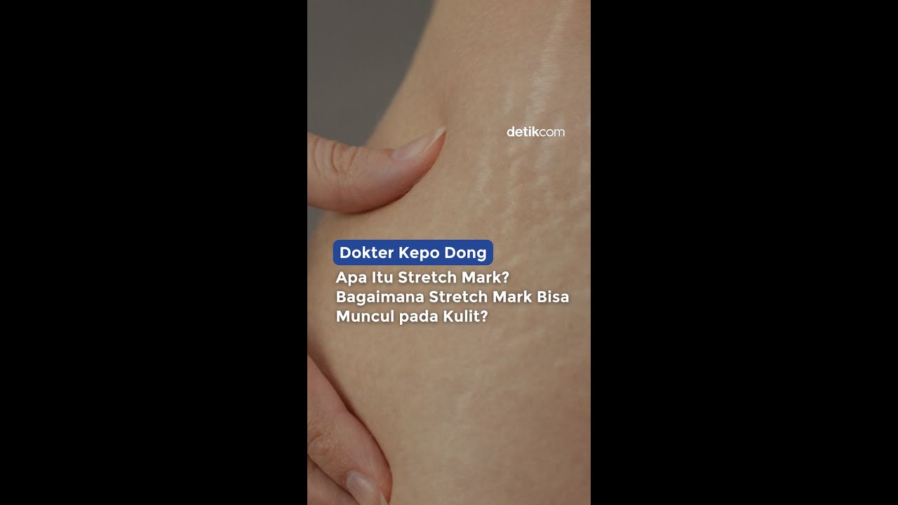 apa-itu-stretch-mark-youtube