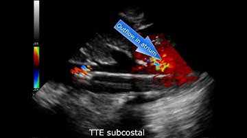 Video 8 Cianchi G et al, Echo-Guided Insertion of a Dual-Lumen Cannula VV ECMO