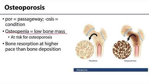 MSK Skeletal System Basics - Aging and Osteoporosis