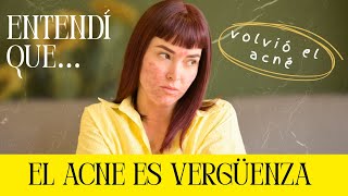 Tuve OTRO episodio de ACNÉ y esto fue lo que me curó