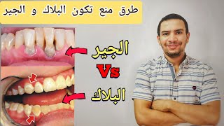 ايهما اخطر البلاك ام جير الاسنان | ما لا يقوله لك طبيب الاسنان