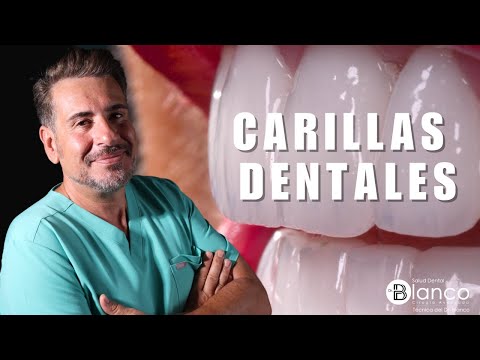 Qué carillas dentales elegir? Tipos, precios y opiniones