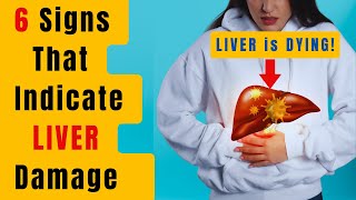 6 Signs That You Have LIVER Damage / SimoHealth by SimoHealth 481 views 2 months ago 8 minutes, 27 seconds