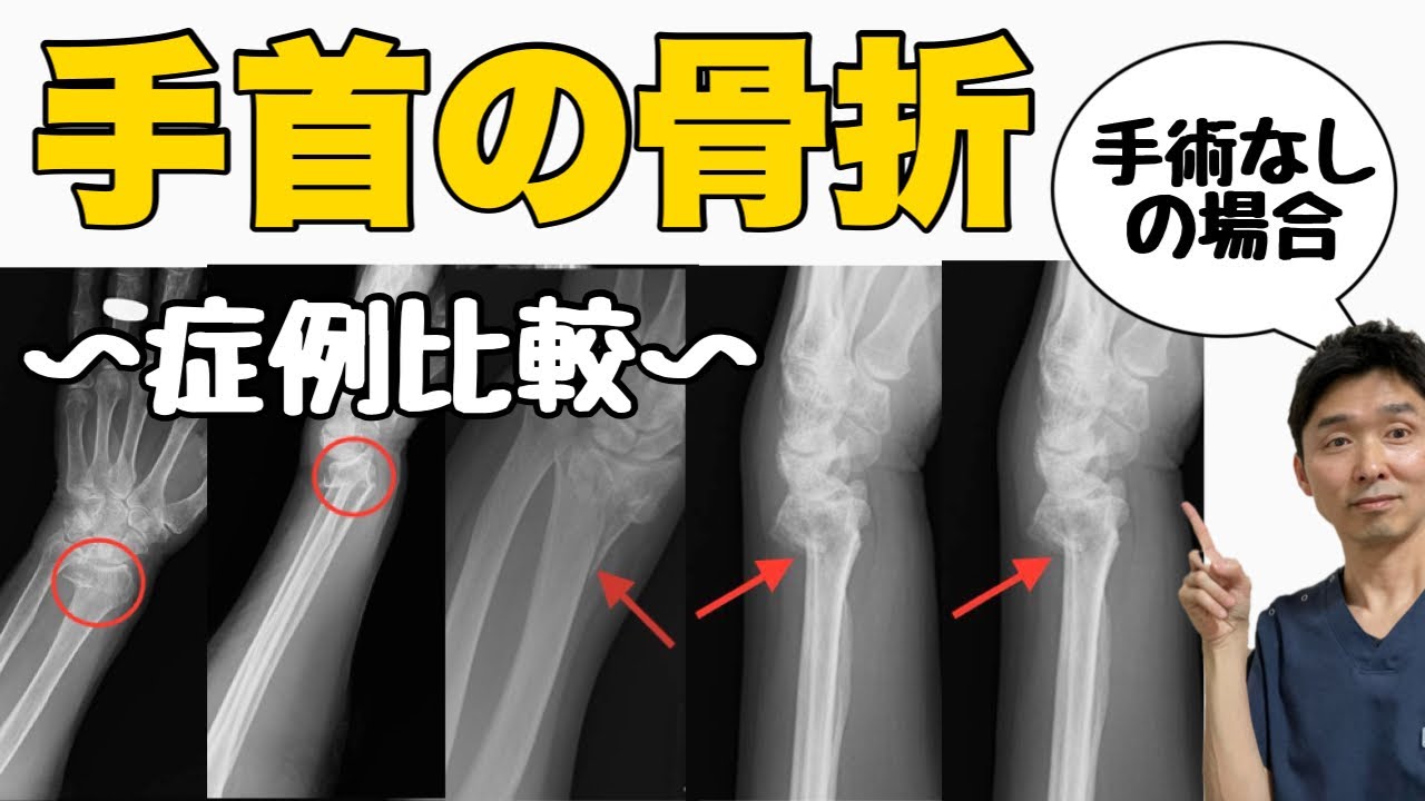 【手首の骨折】手首の骨折早く治す方法〜手首の骨折のリハビリ〜