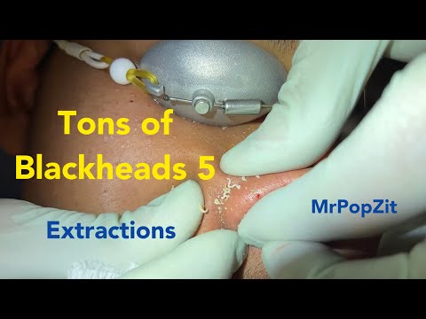 Tons of Blackheads 5. Over a 100 pores extracted. Wait for the nose. Tons of pore dirt and milia.
