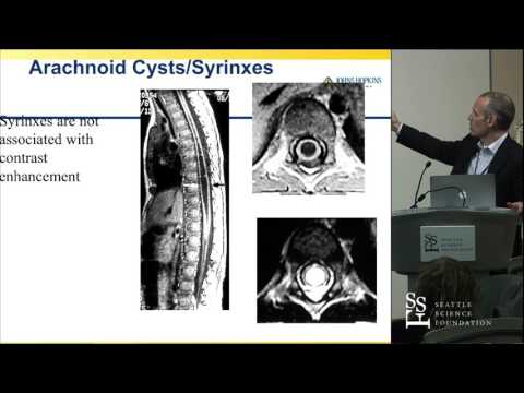 Spinal Cord Tumors - Daniel M. Sciubba, MD