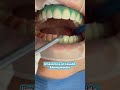 ¿Cómo se hace un blanqueamiento dental? 🦷😊 #shortvideo #shorts