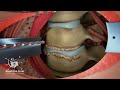 Neck Treatment|Cervical Discectomy|disk replacement in the C6-C7 disk using an implant-a new method