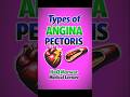 Types of Angina Pectoris | Stable vs Unstable vs Variant Angina ❤️