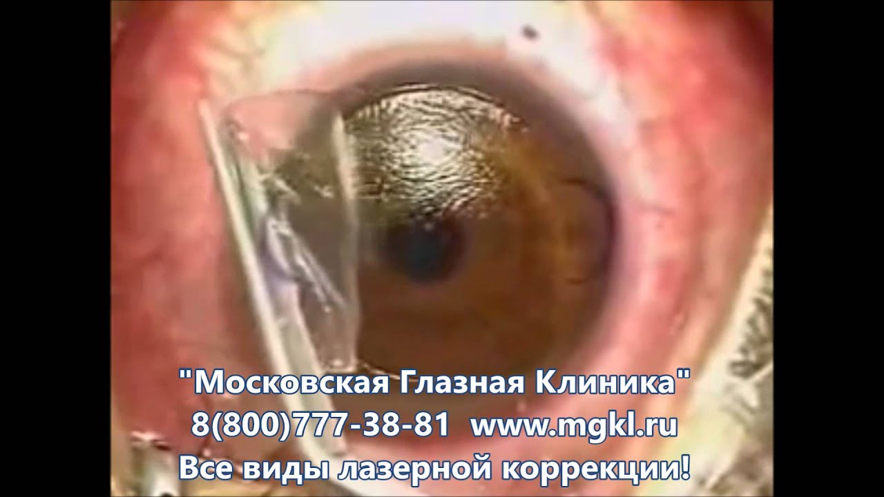 ПресбиЛАСИК - лазерная коррекция зрения при возрастной дальнозокрости ...