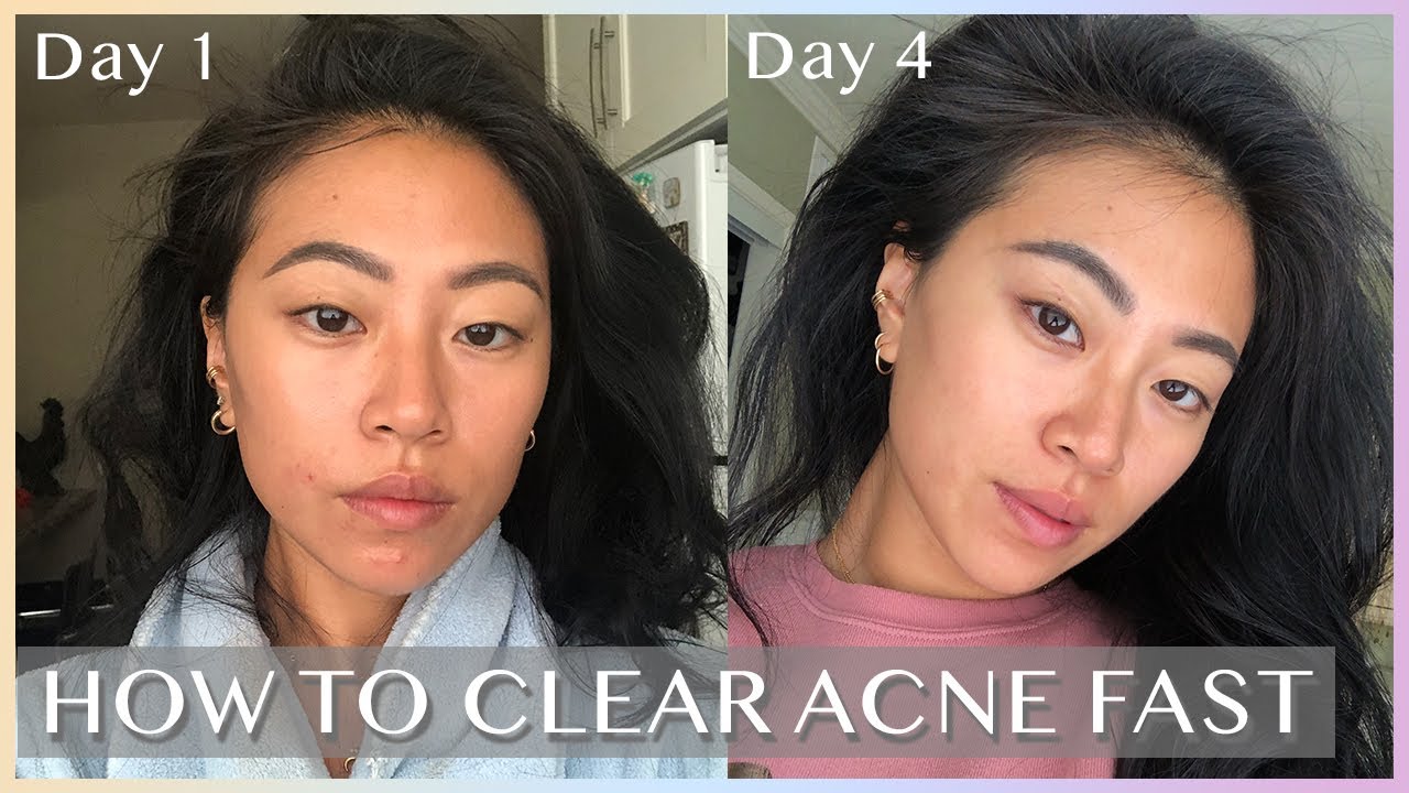blume meltdown cystic acne
