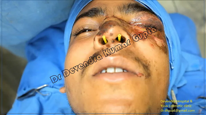 Nasal Fracture reduction under Local Anaesthesia