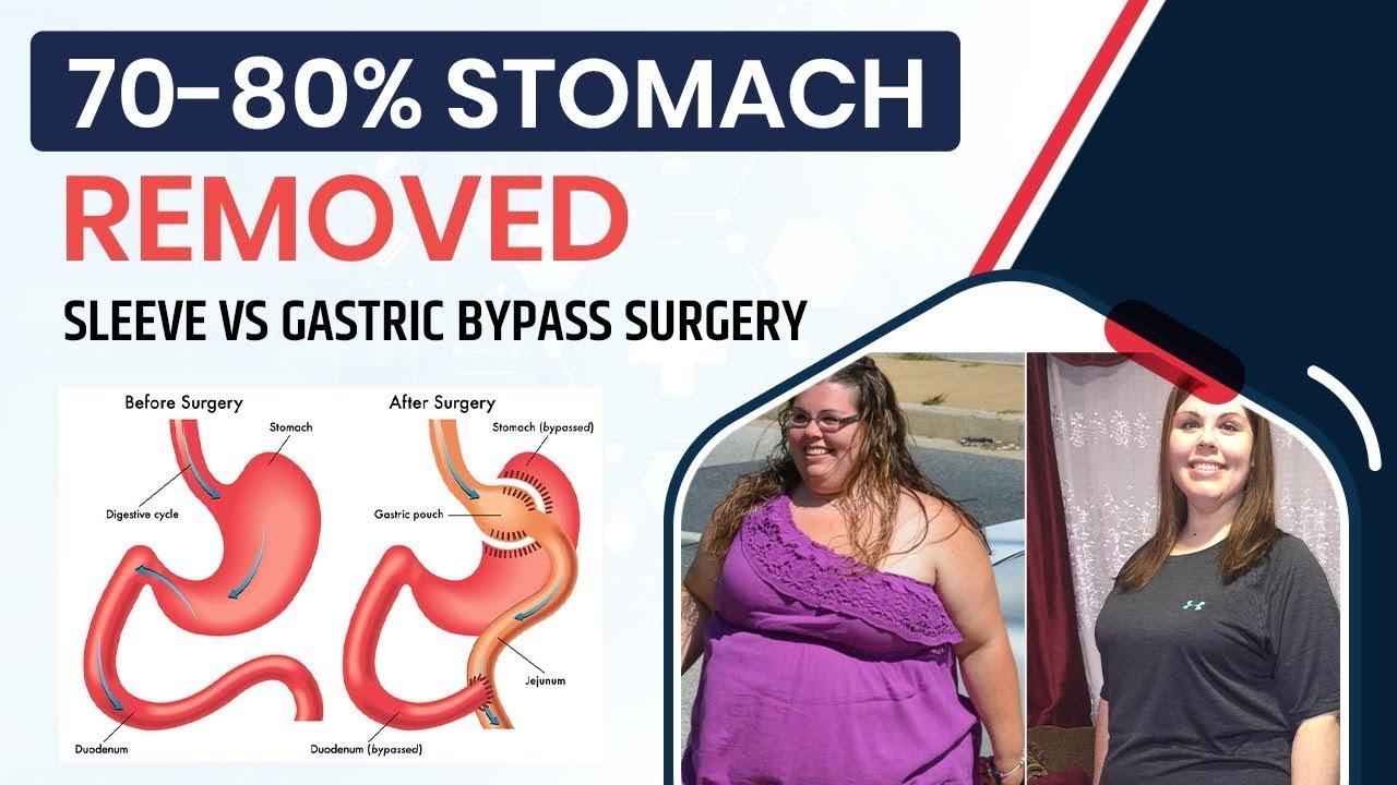 Sleeve vs Bypass, Surgery, for Weight Loss, Pros and Cons, 😱 7080 Of
