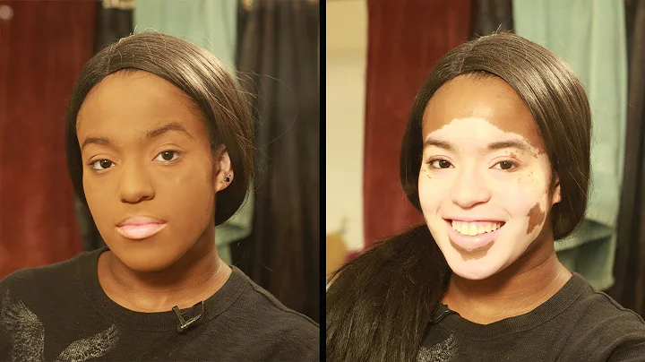 I Wont Hide My Vitiligo With Makeup | SHAKE MY BEA...