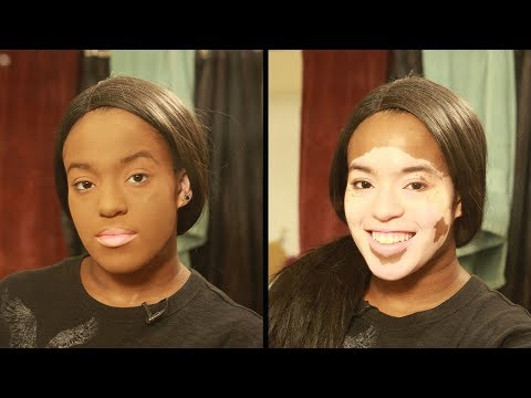 I Won’t Hide My Vitiligo With Makeup | SHAKE MY BEAUTY