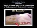 Extensor Carpi Ulnaris Subluxation - Everything You Need To Know - Dr. Nabil Ebraheim