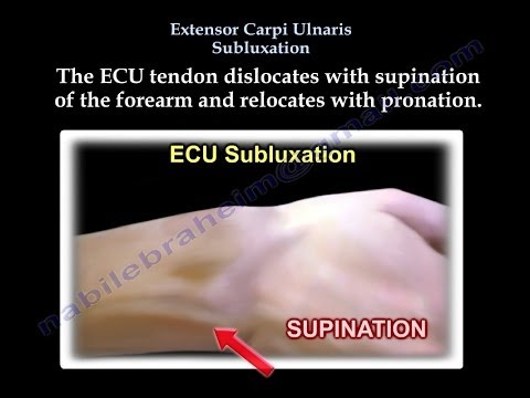 Extensor Carpi Ulnaris Subluxation - Everything You Need To Know - Dr. Nabil Ebraheim