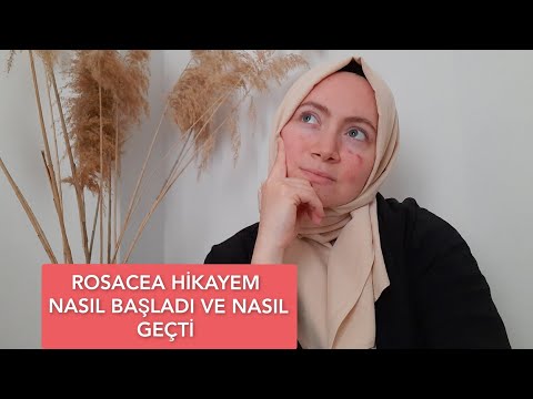 ROSACEA HİKAYEM NASIL BAŞLADI VE NASIL GEÇTİ ✅️ GÜL HASTALIĞI