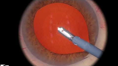 EyeSi CAT C Irrigation and Aspiration, Level 3