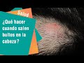 Qué Hacer Cuando Salen Bultos Duros En La Cabeza Salud Qué Hacer Cuando Salen Bultos Duros En La Cabeza Salud