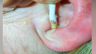 Ear Blackheads, Cysts, Pimples!  Top 10 Amateur Pimple Pops!