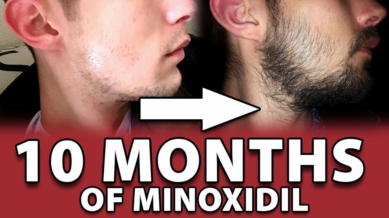 Beard | MONTHS! | Week | Minoxidil for Beard Growth | #Facialfuzzfridays - YouTube