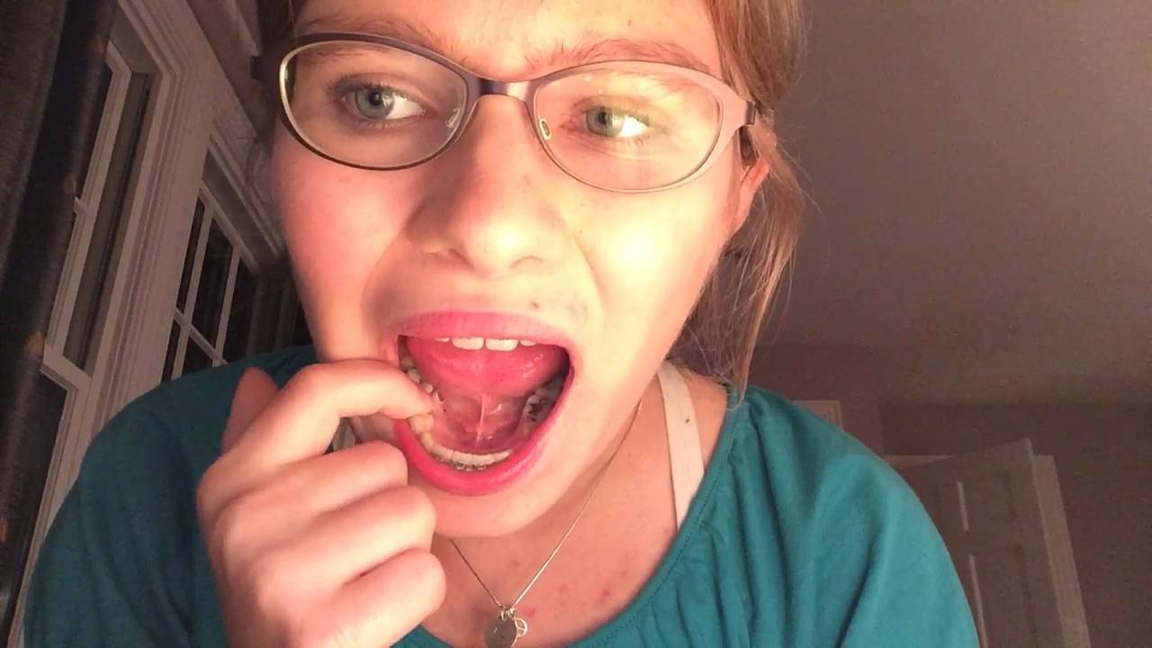 My Wisdom Teeth Consultation YouTube