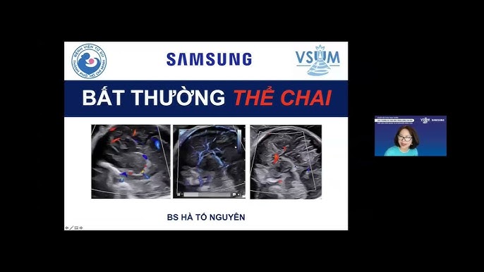 Image hình ảnh hình ảnh hình ảnh hình ảnh hình ảnh hình ảnh hình ảnh Nguyễn Thái Hà - 2.5 Bất thường thể chai - ThS.BS. Hà Tố Nguyên - YouTube