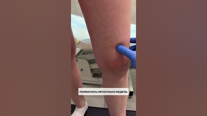 Осложнения случаются, и случаются внезапно #медицина #тромб #варикоз #флеболог #здоровье