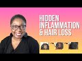 Ccca  early scarring alopecia  hidden causes of excess inflammation  hair loss