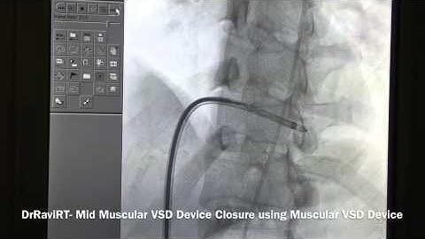 DrRaviRT- MID MUSCULAR VSD DEVICE CLOSURE USING MUSCULAR VSD DEVICE