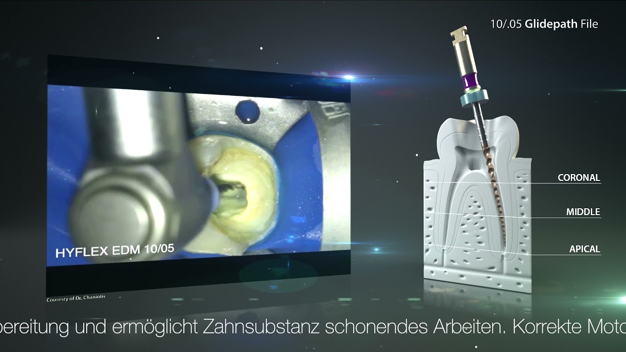 Minimalinvasive Aufbereitung mit der HyFlex™ EDM 10/.05 Gleitpfad Feile