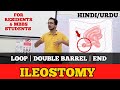 Types of Stoma Explained | Loop vs Double Barrel vs End Ileostomy