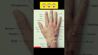 Skin Lesions Explained | Different Types of Skin Conditions on Hand#SkinCare #Dermatology #Skin