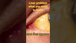 Liver Problems Liver Disease