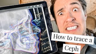 How to trace a Lateral Ceph in orthodontics screenshot 2