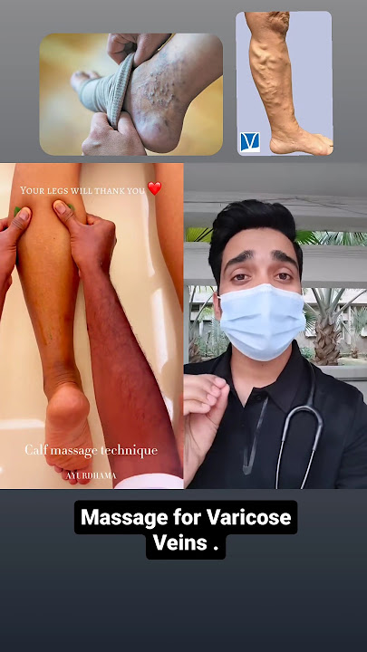 Massage for Varicose Vein.