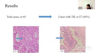 Comparison of PD L1 expression by tumor  & combined proportion score by Dr Parinitha Gaddam