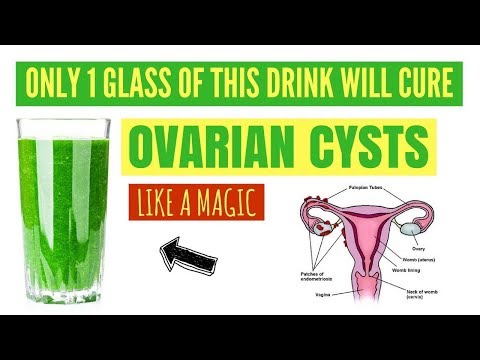 Video: Treatment Of Ovarian Cysts With Folk Remedies, Without Surgery, At Home