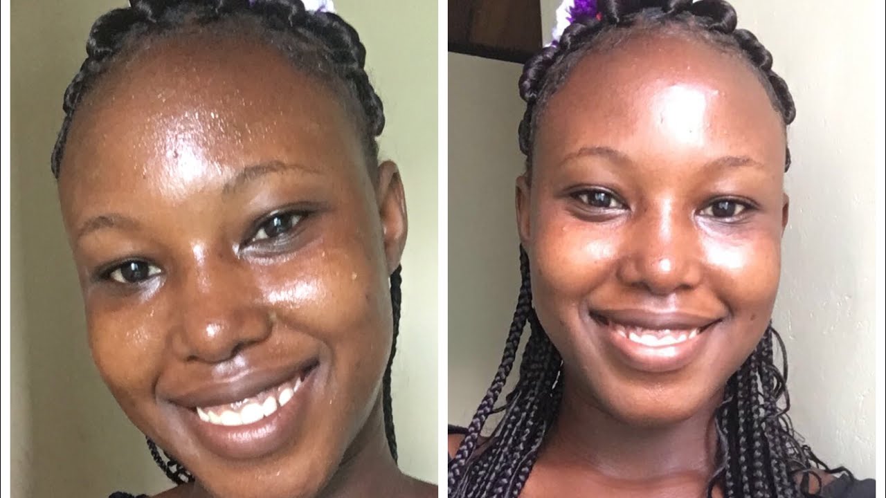 Get A Clear Skin | How To Get Rid Of Hyperpigmentation (Dark spots