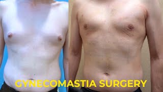 Gynecomastia Surgery: 24 Hours Post Op