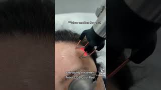 Download Lagu Tetra CO2 Coolpeel Laser Treatment / anti-aging skin care treatment! MP3