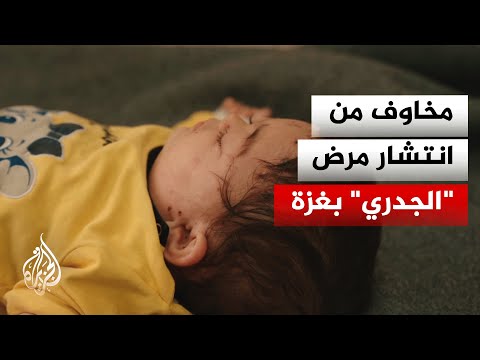 أصوات من غزة | غياب الخدمات والحرارة المرتفعة يثيران المخاوف من انتشار الجدري