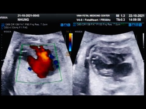 Video Siêu âm tim thai 29 tuần: Tứ chứng Fallot Kênh nhĩ... - youtube
